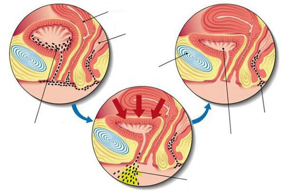 bactérias na bexiga com cistite