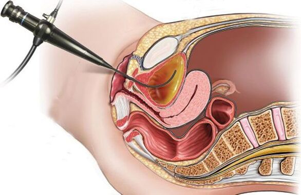 cistoscopia para cistite