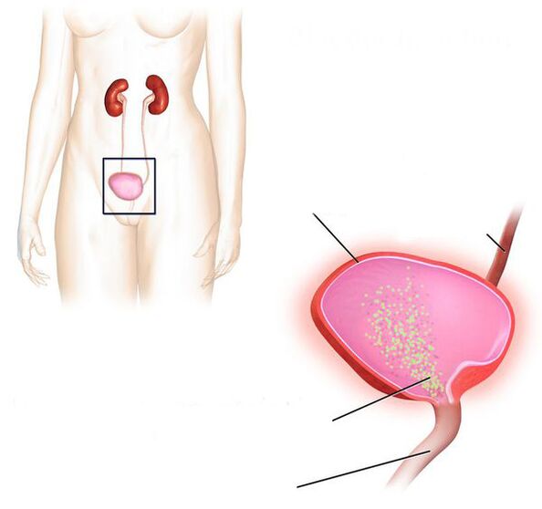 inflamação da bexiga